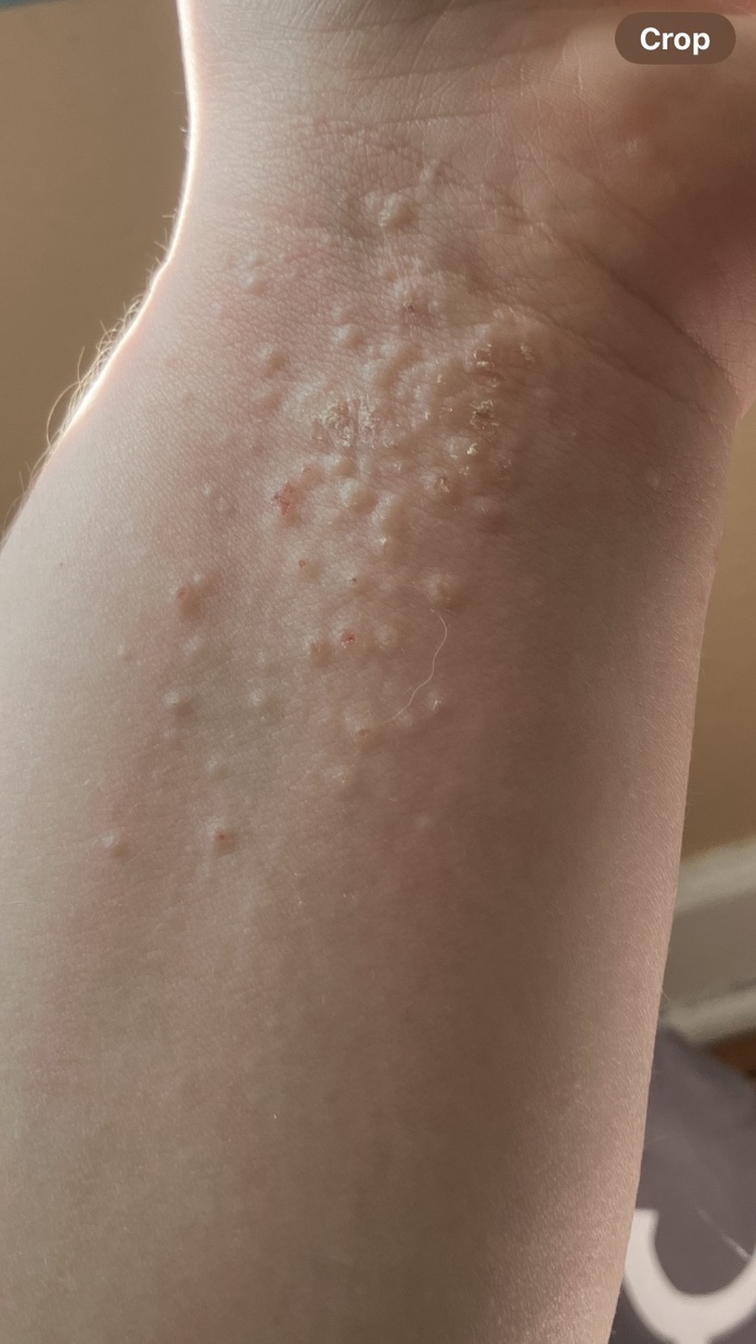 Is this eczema?