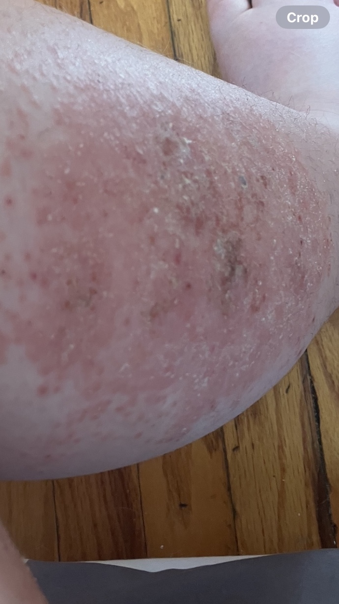 Is this eczema?