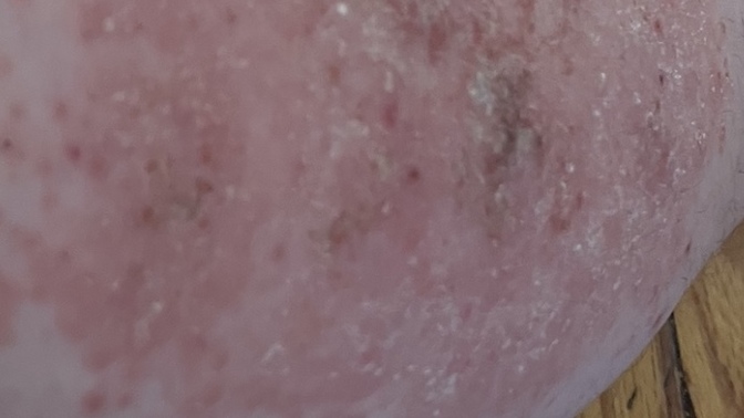 Is this eczema?