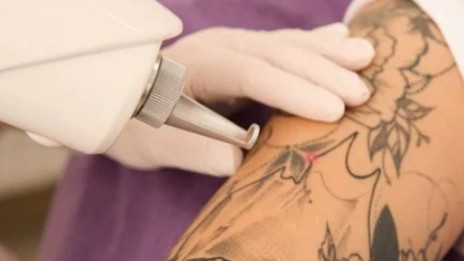 People who have had tattoos removed, how much did it cost and how big was it?