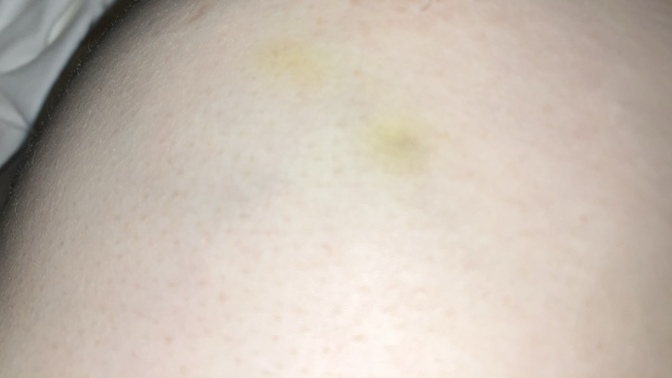 What are these? yellow dots on my breasts?