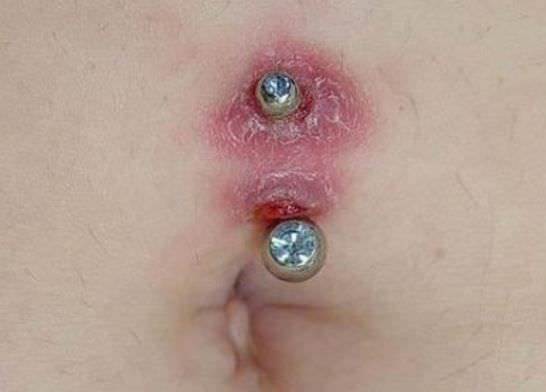 Is it normal for a belly button piercing to bleed after 2 months?