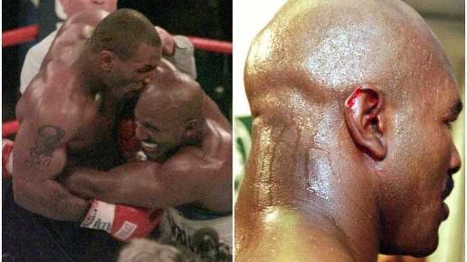Would you forgive someone who bit part of your ear off like Tyson did to Holyfield?
