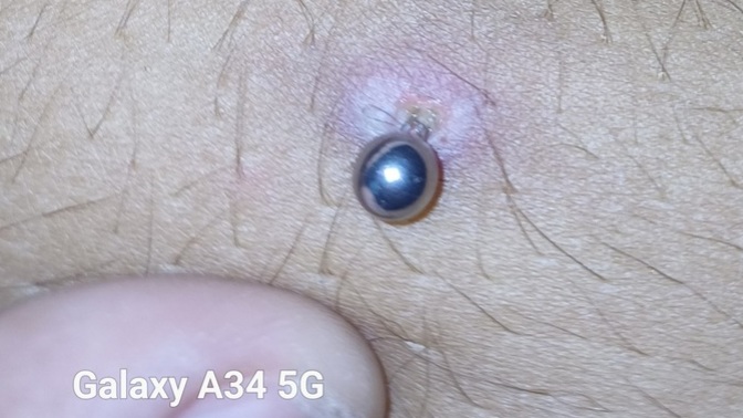 Is it healing or infected?