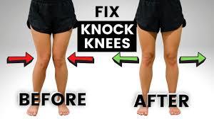 During puberty why do 7 most girls have knock knees?