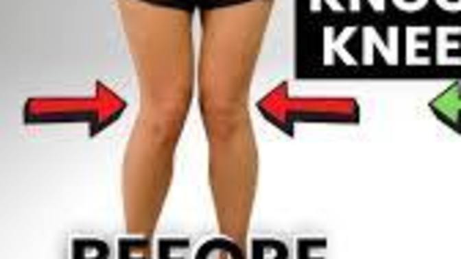 During puberty why do 7 most girls have knock knees?