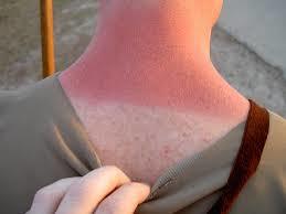 Most white people get sunburn easy. Do other races give sun burn as well or tan line?