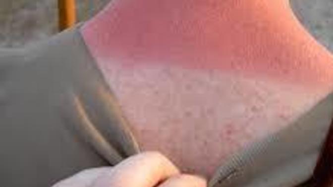 Most white people get sunburn easy. Do other races give sun burn as well or tan line?