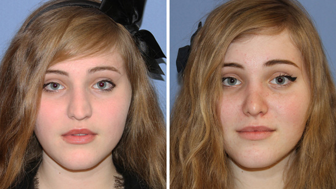 Do you think people under the age of 18 should be allowed to get surgery for cosmetic reasons?