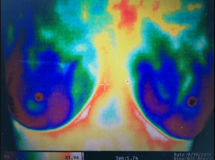 Girls, have you ever had a mammogram or biopsy?