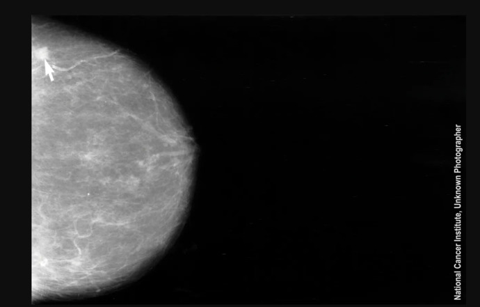 Calcium deposit, not cancer