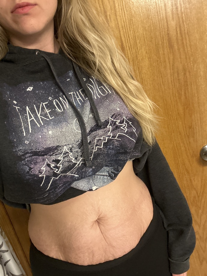 Stretch marks and loose skin? Dealbreaker?