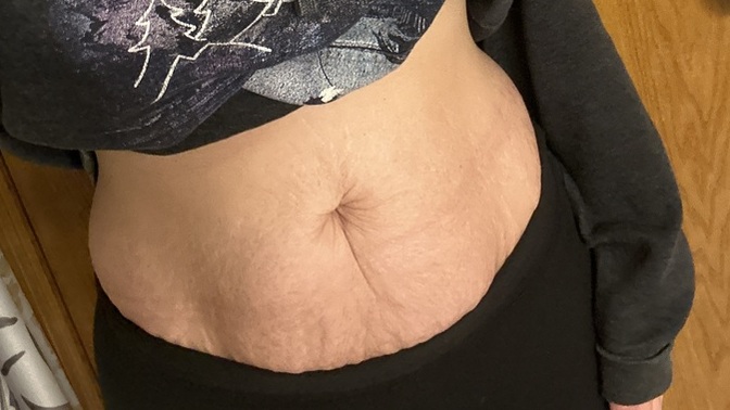 Stretch marks and loose skin? Dealbreaker?