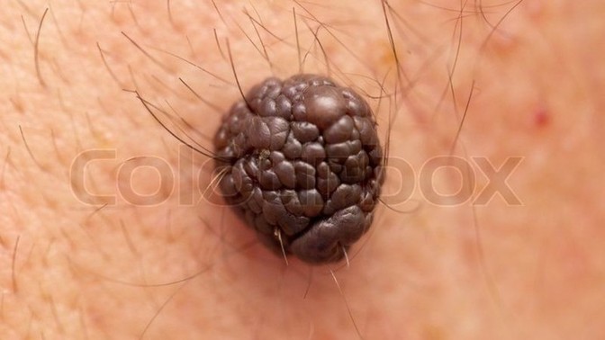 Could you date someone with a MOLE? Not a beauty mark?