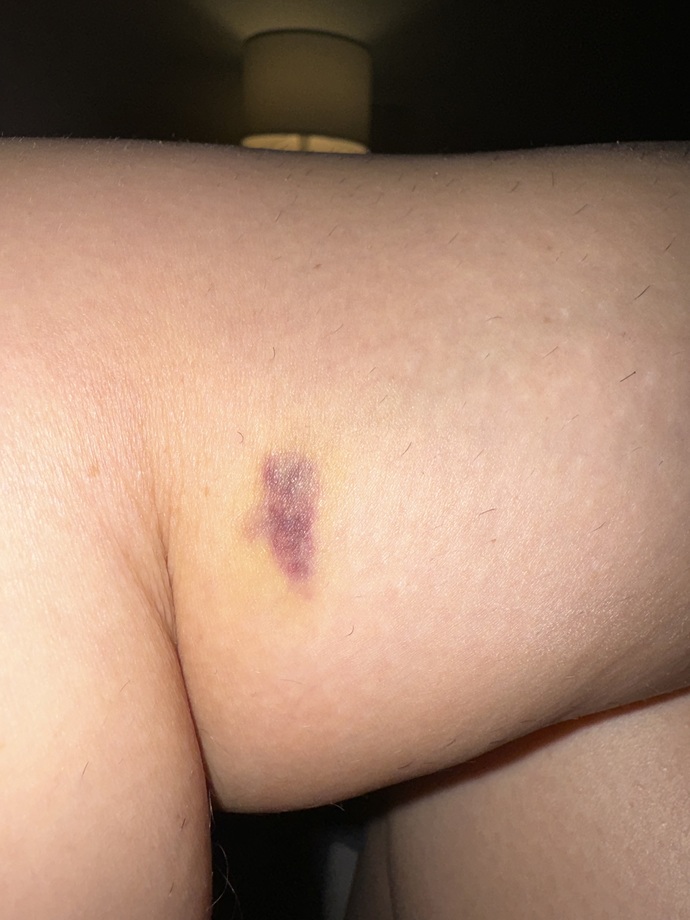 Is this a bruise or skin cancer?