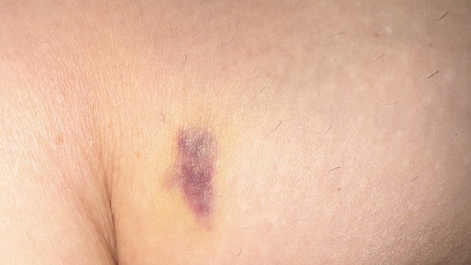 Is this a bruise or skin cancer?