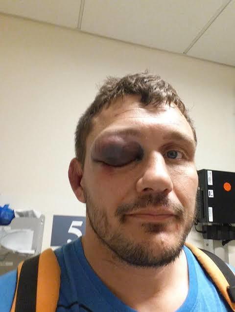 When eyes are closed after being hit like this, does it become blind?