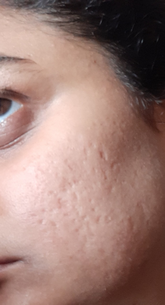 An unfiltered image of post acne scars