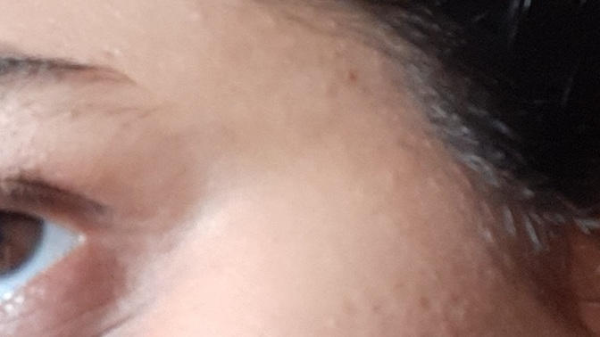 Men, do you find post acne scars on women unattractive?