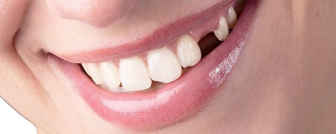 What do you do when you have no money to fix your tooth?