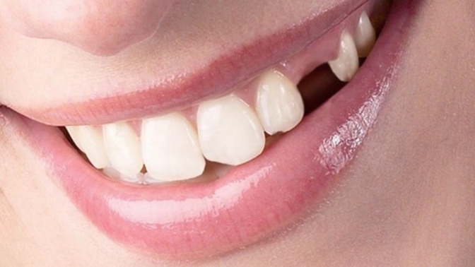 What do you do when you have no money to fix your tooth?