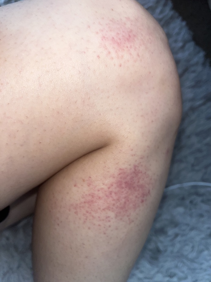 What kind of rash is this ( pic ) ?