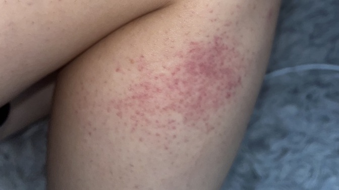 What kind of rash is this ( pic ) ?