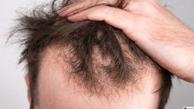 I’m not attracted to bald man and my husband is balding. How can I stopped it?