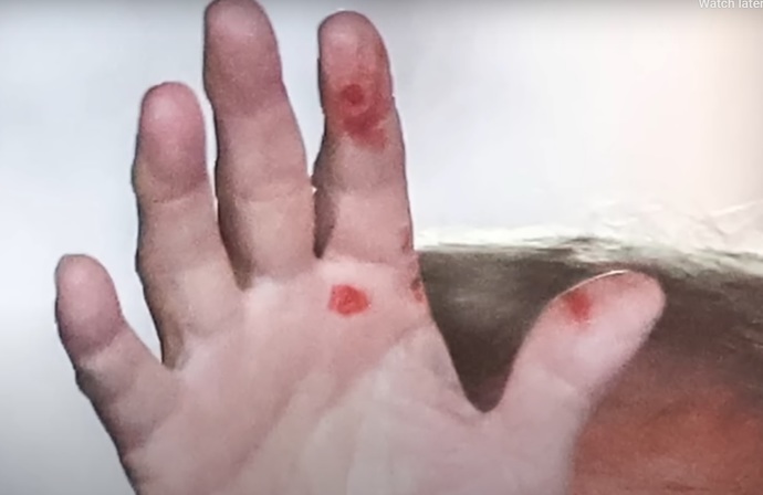 Does Trump have syphilis?