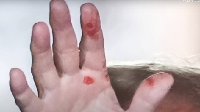 Does Trump have syphilis?