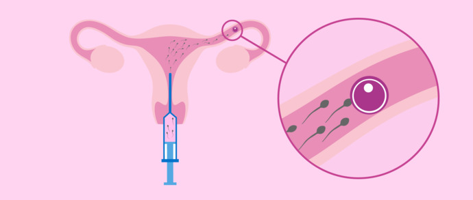 Artificial Insemination