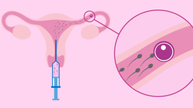 Should a man donating sperm in a container with a written agreement he would have nothing to do with the child be required to pay child support?