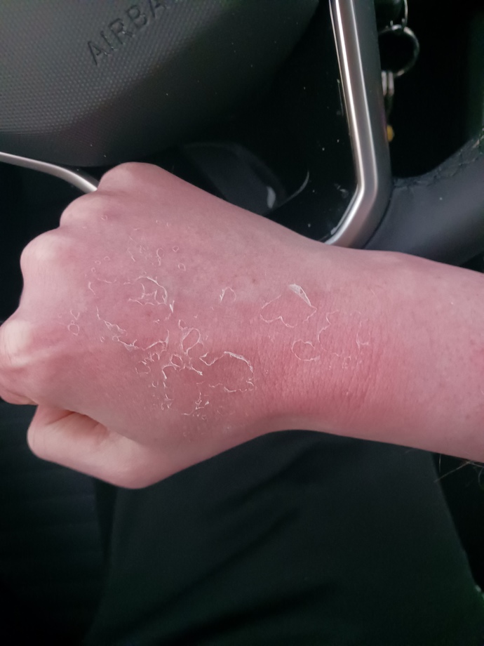Why does your skin shed after you get sunburn like a snake?