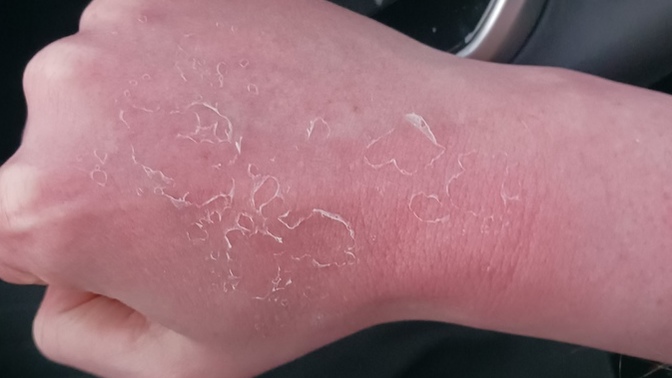 Why does your skin shed after you get sunburn like a snake?