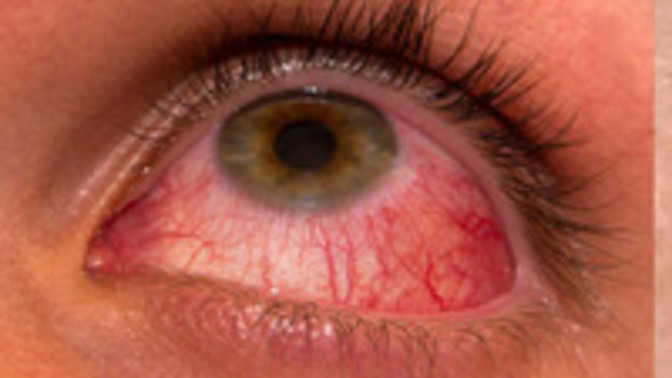 Any tips on how to deal with super veiny red eyes?