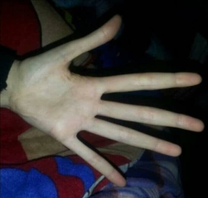 Marfans Syndrome - elongated fingers/limbs