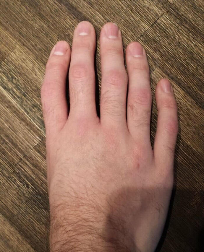 Triphalangeal Fingers