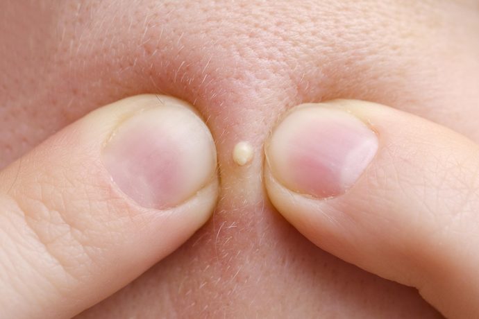 Do you POP a PIMPLE or hope it goes away?