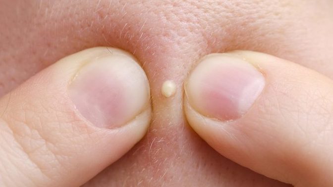 Do you POP a PIMPLE or hope it goes away?
