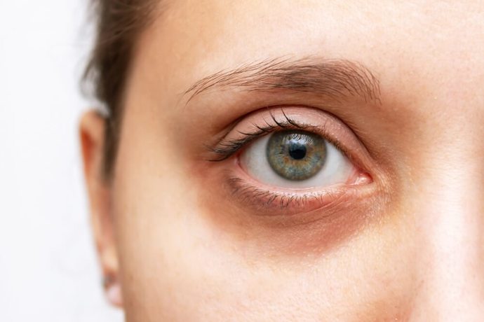 How do you deal with dark circles under your eyes?