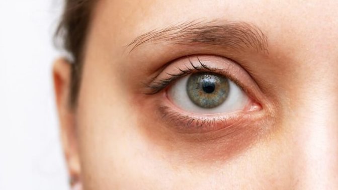 How do you deal with dark circles under your eyes?