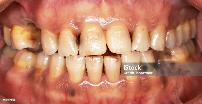 SMOKER'S TEETH