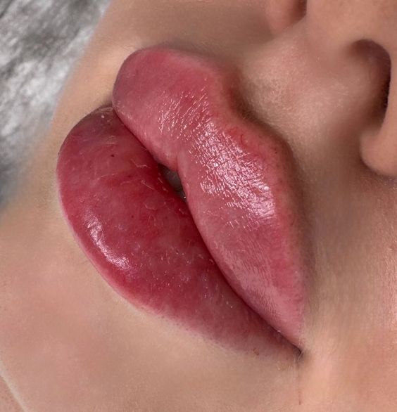 Do you think lip fillers enhance or ruin beauty?