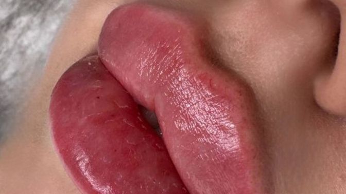 Do you think lip fillers enhance or ruin beauty?