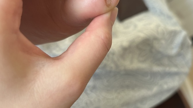 What is this on my toes?