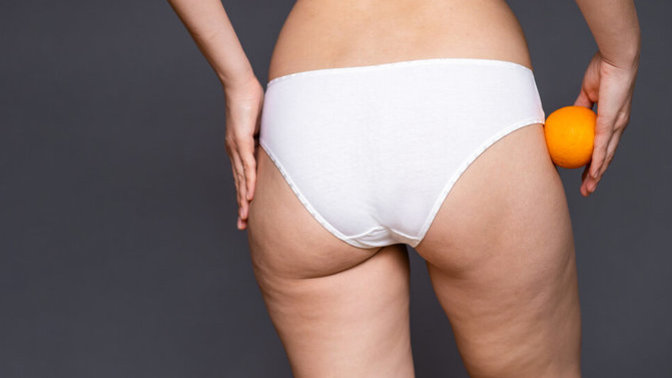 Guys, do you notice cellulite or stretch marks on a woman?