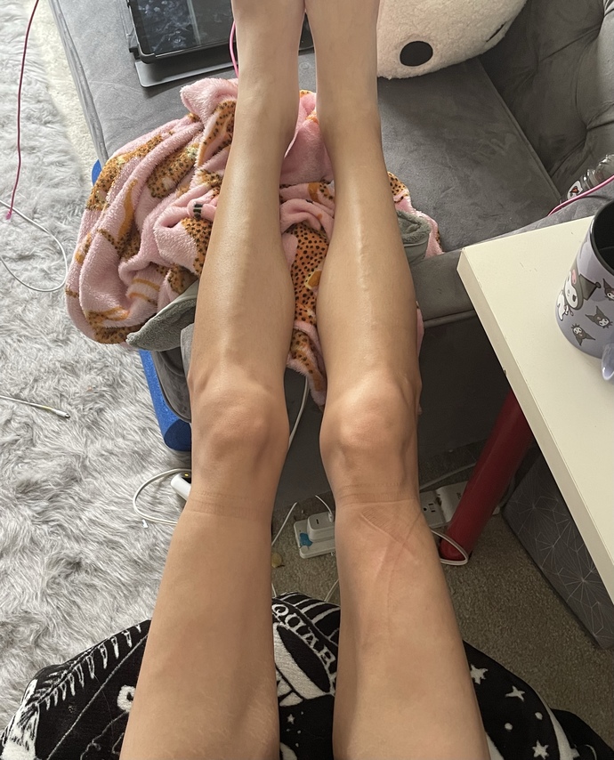 Do I look like I have edema?