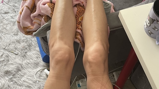 Do I look like I have edema?