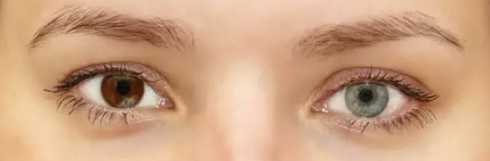 Do you find Heterochromia attractive?