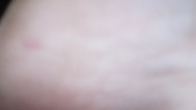 Does this look serious does this look like a diabetic foot ulcer?